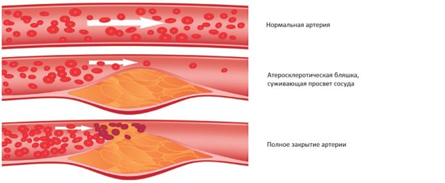 Оторвавшиеся тромбы также могут блокировать сосуды, попадая в них посредством кровотока