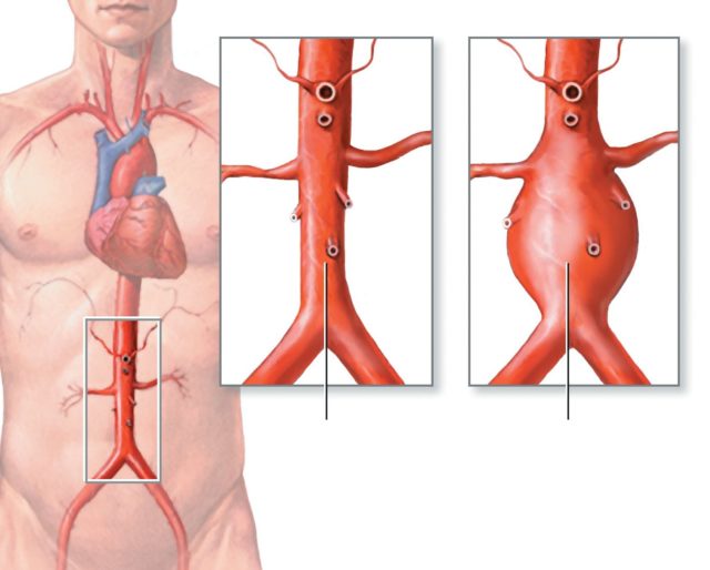 При блокировании брюшной артерии возникает ишемия бедра и нижних конечностей