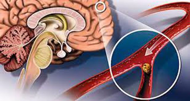Тромбоз периферических артерий требует незамедлительного лечения