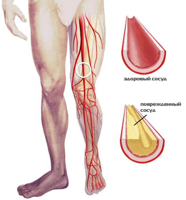 Артериальный тромбоз предполагает формирование сгустков крови в полости сосудов, снабжающих кровью внутренние органы