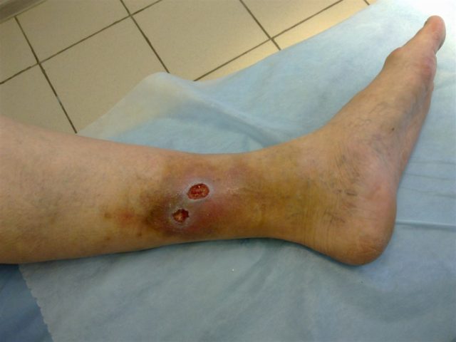 Незаживающие раны быстро распространяются на обширные площади кожных покровов и заходят вглубь, затрагивая различные ткани