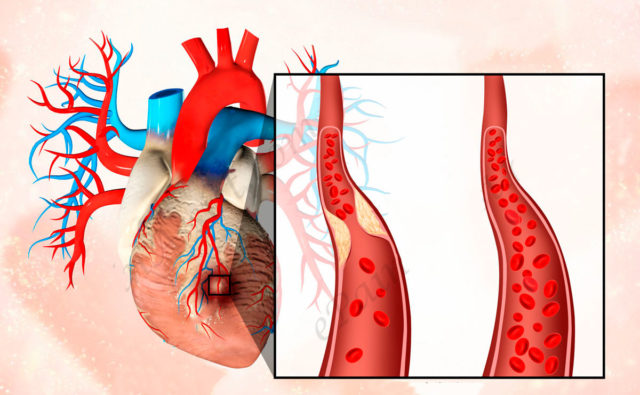Инфаркт возможен, если возникает недостаточность коронарного кровотока и недостаточное снабжение кислородом миокарда