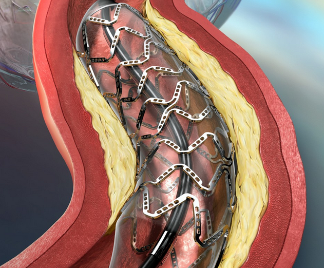 Если закупорено несколько коронарных артерий или если в левой главной артерии есть значительная закупорка,шунтирование является лучшим решением проблемы