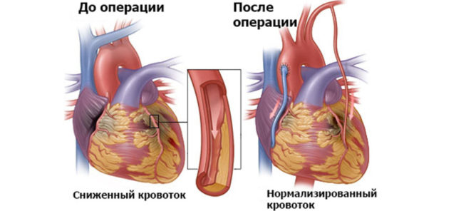 С этой целью здоровые артерии присоединяются к коронарным, таким образом, кровообращение осуществляется, минуя пораженные участки