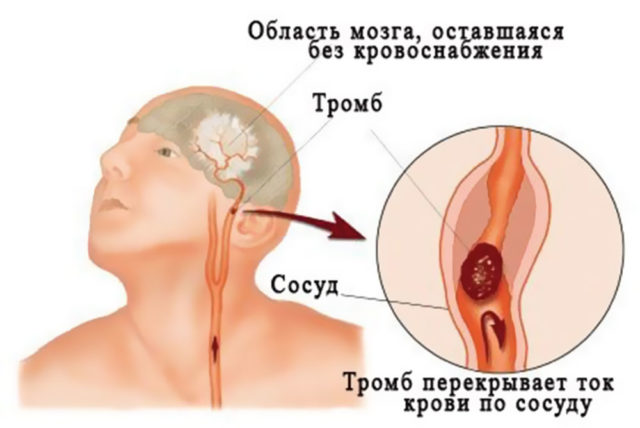 Лечение ситуативное и зависит от количества сопутствующих тромбозу головных вен патологических факторов