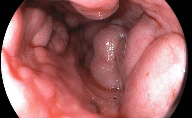 Приобретенная форма варикоза в пищеводе развивается вследствие портальной гипертензии – болезни, при которой в воротной вене повышается давление