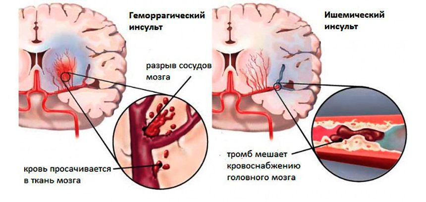 Ишемический и геморрагический инсульт
