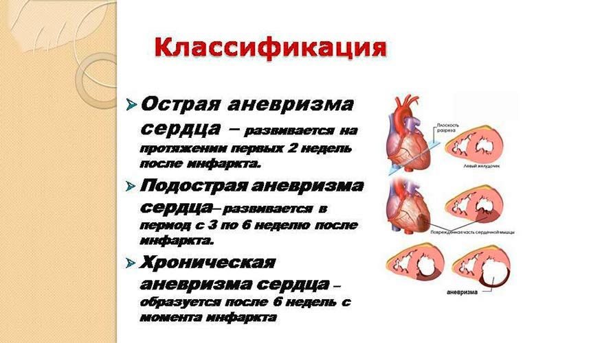 Аневризма сердца клиника