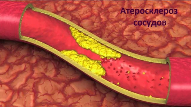Основным проявлением болезни являются атеросклеротические бляшки, которые выступают в просвет пораженного сосуда и создают препятствие кровотоку