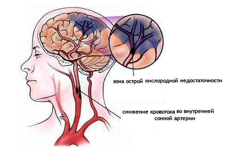 Ишемия головного мозга